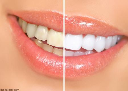 Karbonat İle Diş Beyazlatma Nasıl Yapılır?