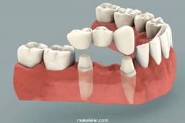 Sabit Protez Nedir, Hangi Hastalara Uygulanır?